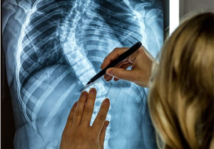 Scoliosis Treatment Blog Post Utah Physical Therapy