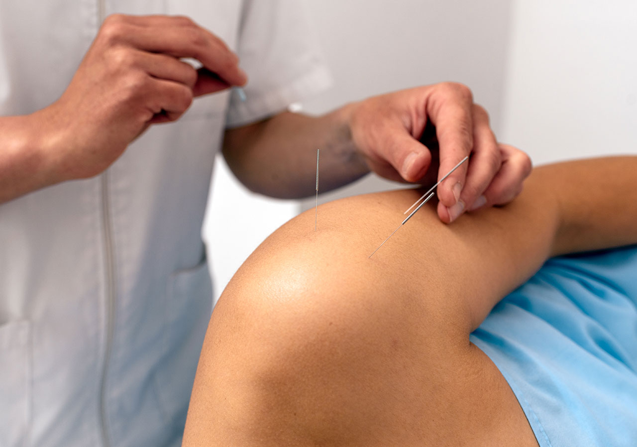Dry Needling Therapy Utah Physical Therapy